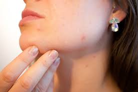 Acne: anche in età adulta?